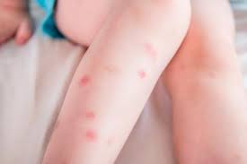 Cómo prevenir y tratar picaduras de insectos en verano