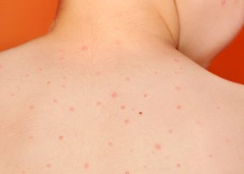 Piojos, verrugas y moluscos contagiosos: Cómo enfrentar a los intrusos del verano