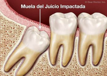 Muela del juicio: Extracción a temprana edad reduce el riesgo de pericoronaritis