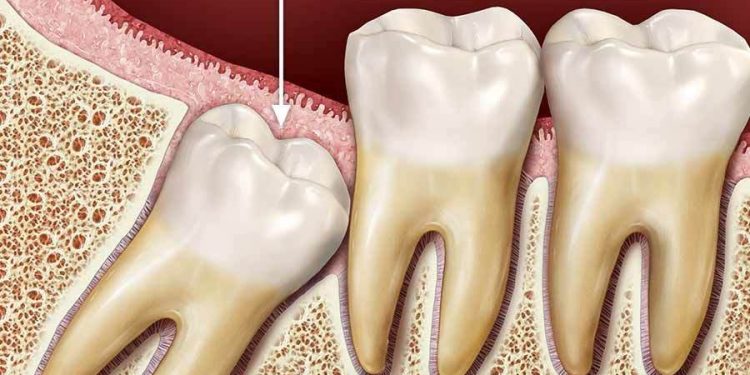 Muela del juicio: Extracción a temprana edad reduce el riesgo de pericoronaritis