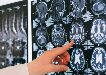 Día Mundial del Cerebro: Hasta el 90% de algunos ACV podrían prevenirse