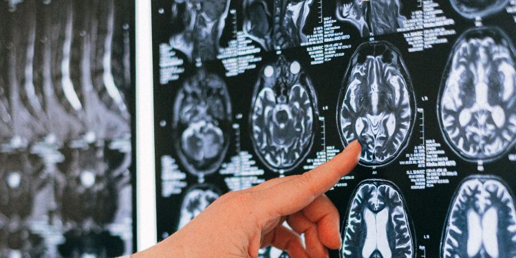 Día Mundial del Cerebro: Hasta el 90% de algunos ACV podrían prevenirse