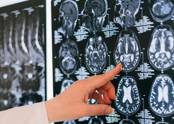 Día Mundial del ACV: Cada minuto sin tratamiento se pierden dos millones de neuronas