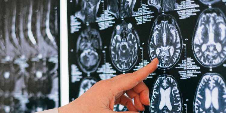 Día Mundial del ACV: Cada minuto sin tratamiento se pierden dos millones de neuronas