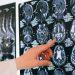 Día Mundial del ACV: Cada minuto sin tratamiento se pierden dos millones de neuronas